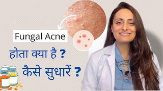 Fungal acne kya hota hai  kaise control kare  Tvacha ke doctor  Dr Aanchal Panth [upl. by Ximena]