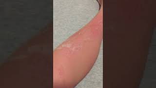 Skin Peeling from Sunburn asmr [upl. by Ennairek]