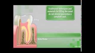 GuttaFlow2 D Root Canal Filling System [upl. by Llertram]