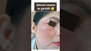 Steroid creams का दुरूपयोग 😥 Medisalic Betnovate MemopiHC No scars का उपयोग खुद से कभी ना करें [upl. by Adnesor]