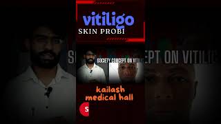 Vitiligo fact Nepali 2024 [upl. by Llewellyn2]