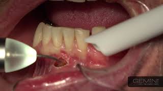 How To Use the Gemini Laser Lower Anterior Frenectomy [upl. by Jemina]