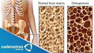 ¿Qué es la Osteoporosis  Cómo prevenir la osteoporosis [upl. by Hammel]