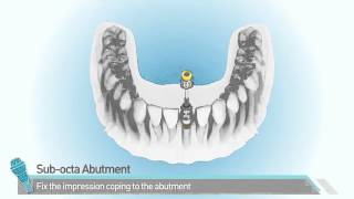 DENTIS Implant Cleanlant Subocta Abutment [upl. by Zaneta630]