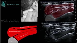 Sonographische Darstellung der kurzen Nackenmuskeln [upl. by Zeralda173]