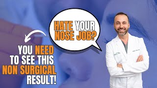 Non Surgical Revision Rhinoplasty [upl. by Loughlin]