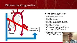 ECMO VA ECMO For Dummies [upl. by Lorrimor]