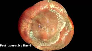 EPIRETINAL MEMBRANE [upl. by Acirretal]