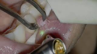 Solea Fibroma Removal Dr Jeffrey Rohde [upl. by Ranger69]