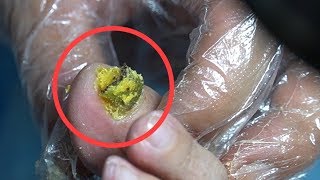 TOP MEDICAL PEDICURE PODIATRY 16  disgusting foot fungus nails clipping [upl. by Nidya]