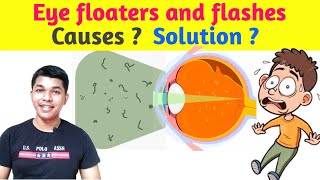 What causes Eyefloaters Eye Flashes  How to cure eyefloaters  SCIENCE COLLECTOR [upl. by Essyla]