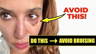 How to Prevent Bruising from Botox and Filler DO THIS Before you get Facial Injections [upl. by Annawaj537]