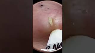 Blackheads Removal  Acne Treatment and Very Satisfying Satisfying Pimple pop blackheads [upl. by Elfreda827]