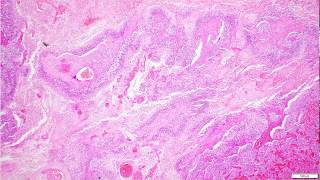 Glioblastoma IDH Wildtype Histopathological Diagnosis [upl. by Garceau]