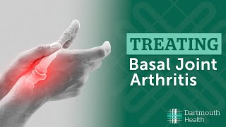 Basal Joint Arthritis [upl. by Hildick926]