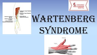 Wartenberg Syndrome  Superficial Radial Nerve Compression Neuropathy [upl. by Stevens]