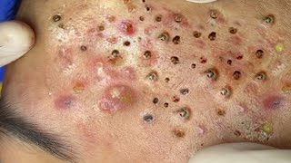 Big Cystic Acne Blackheads Extraction Blackheads amp Milia Whiteheads Removal Pimple Popping  2313 [upl. by Whiteley]