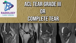 ACL Tear Grade III or Complete [upl. by Caralie]