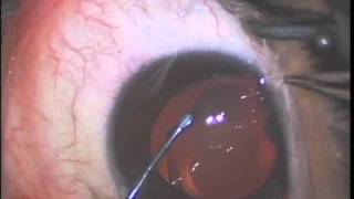 Implantable Collamer Lens Visian ICL implantation [upl. by Eatnoled]