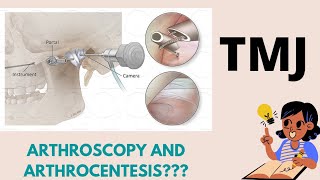 Temporomandibular joint TMJ Arthroscopy and ArthrocentesisBasics Short note [upl. by Aciamaj393]