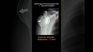 Posterior shoulder dislocation Y view 69 Xray Upper limb Glenohumeral joint radiologychannel007 [upl. by Anirod]