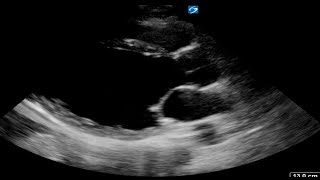 Dilated CMPMyocarditis [upl. by Klump]