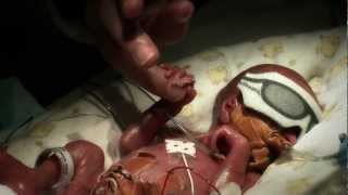 24 week premature baby  Tobys journey [upl. by Eelyrag]