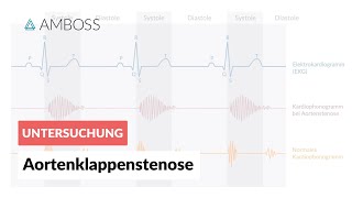 Aortenklappenstenose  Herzgeräusch  AMBOSS Video [upl. by Keily]