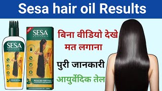 Sesa hair oil results  sesa hair oil kaise use kare  sesa hair oil review  Drx Rabbani [upl. by Geer]