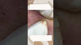 Big Cystic Acne Blackheads Extraction Blackheads amp Milia Whiteheads Removal Pimple Popping [upl. by Narag423]