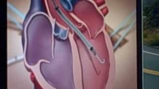 Impella 50 animation showing how it aids heart failure patients [upl. by Afital207]