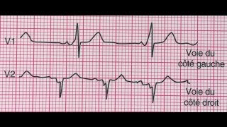 Syndrome de WolffParkinsonWhite [upl. by Nho]