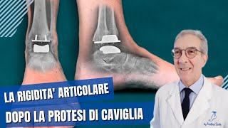 Perchè muovere subito la caviglia dopo lintervento di protesi di caviglia  Dott Andrea Scala [upl. by Juieta64]