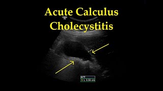 Acute Cholecystitis with Cholelithiasis  Ultrasound  Case 18 [upl. by Alyda]