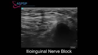 Ultrasound Guided Ilioinguinal nerve block [upl. by Iralav]