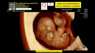 Fetal demised IUFD 10 weeks [upl. by Pelaga]