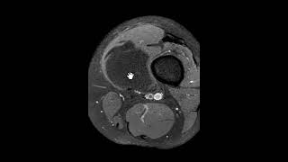 Intramuscular lipoma of the thigh [upl. by Waterman742]