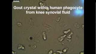 Live Synovial Gout phagocyte Showing Negative Birefringent Characteristic MSU Crystal [upl. by Athal]