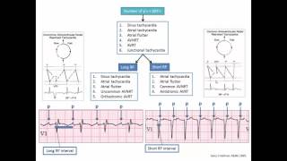 ECG Session Narrow and Wide Complex Tachycardia [upl. by Aneras204]