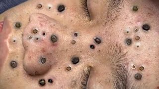 Big Cystic Acne Blackheads Extraction Blackheads amp Milia Whiteheads Removal Pimple Popping  1213 [upl. by Tyika289]