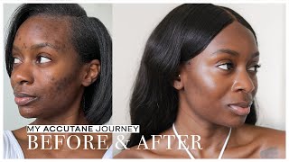 How I Cleared My Acne After 18 Years  Accutane Journey Side Effects Before amp After [upl. by Angid]