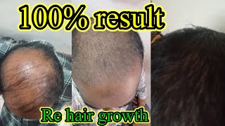 Re Hair growth treatment  बाल उगाणे का ट्रीटमेंट  hairgrowth hairtransformation [upl. by Michal]