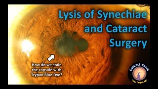 Lysis of Synechiae and Cataract Surgery  Tips amp Tricks [upl. by Laro]