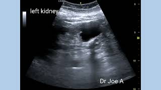 Renal cortical cyst Bosniak type 2F  ultrasound and color Doppler video [upl. by Yran346]