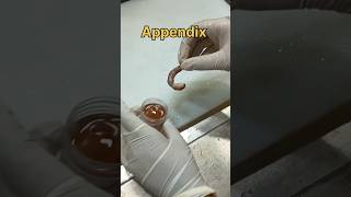 Appendicitis specimen [upl. by Eniloj]