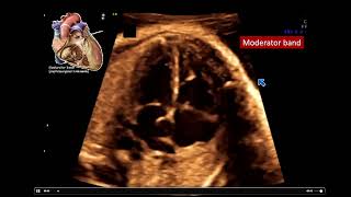 2022 Fetal Echocardiography Normal and Abnormal Hearts  A Video CME Teaching Activity [upl. by Suoivatram]