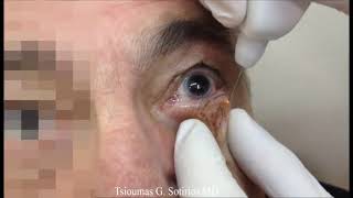 Correction du trichiasis entropion [upl. by Lance]