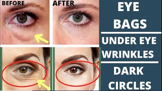 HOW TO GET RID OF PUFFY EYES AND EYE WRINKLES WITH EYE REJUVENATION EXERCISES [upl. by Laynad]