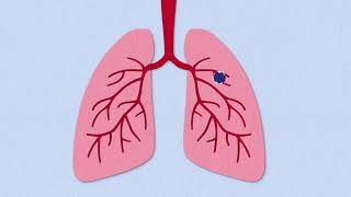 Fibrosis Explained [upl. by Tupler]