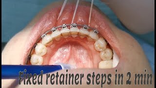 Fixed orthodontic retainer steps [upl. by Aihppa409]